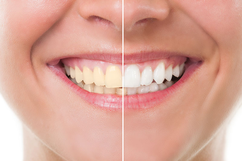 Teeth Whitening in Peru